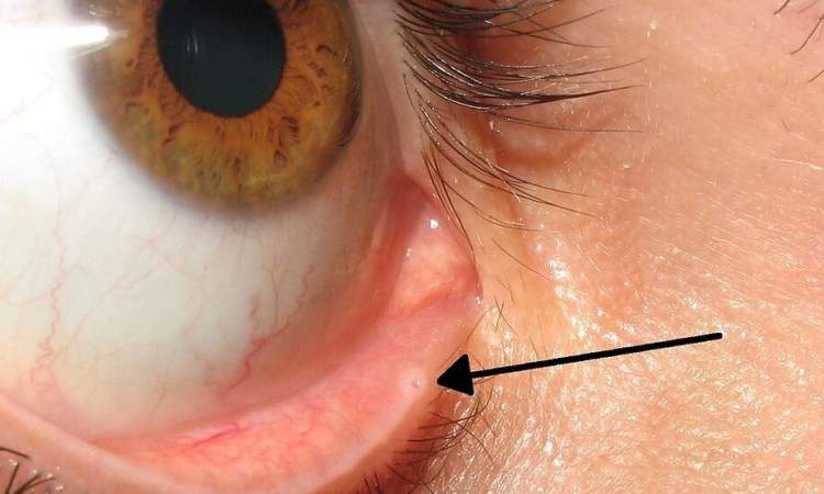  ما الذي تفعله الثقوب الصغيرة في جفوننا !