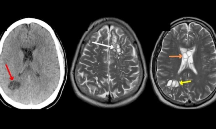 أمريكي يعاني من صداع نصفي والسبب دودة في دماغه! من اين جائت!? صورة