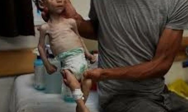 20 ألف طفل نقلوا للمستشفيات بسبب سوء التغذية الحاد في غزة