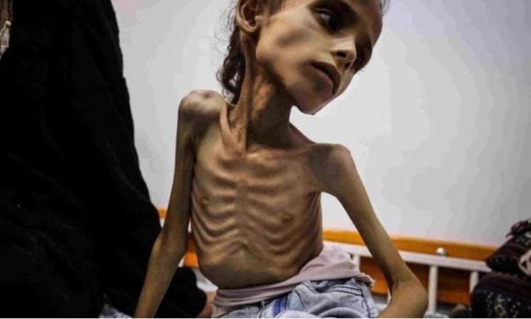 صحة غزة: ارتفاع وفيات التجويع الإسرائيلي إلى 193 بينهم 96 طفلا