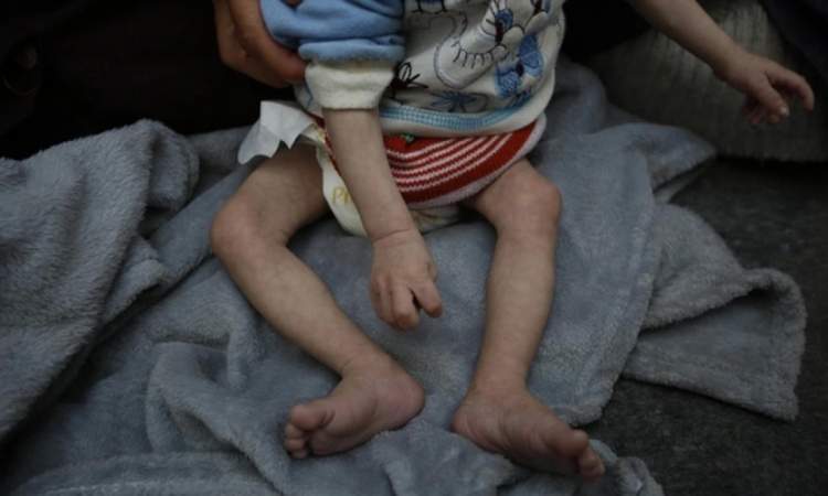 وفاة 11 فلسطينياً بينهم طفلين خلال الـ24 ساعة الماضية نتيجة المجاعة وسوء التغذية